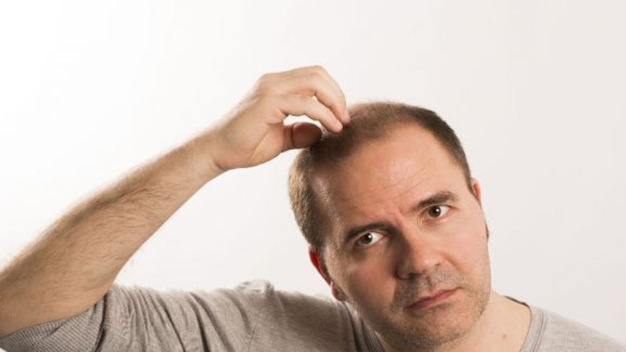 Uzmanlara göre saç ekiminde doğal görünüm önemli