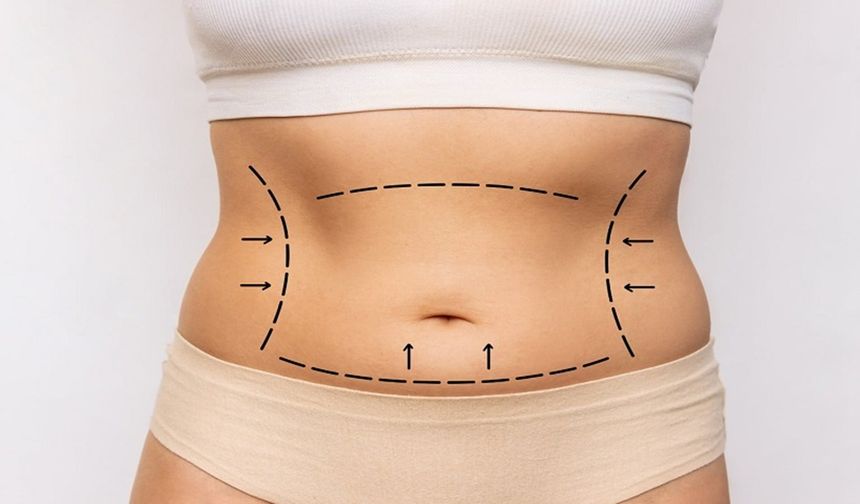 Karın Germe Ameliyatı (Abdominoplasti) Nedir?